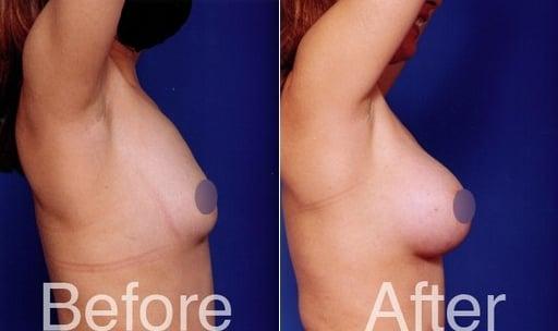 Looking to get a breast augmentation? Here is an example of the spectacular and natural results Dr. Cher can give you