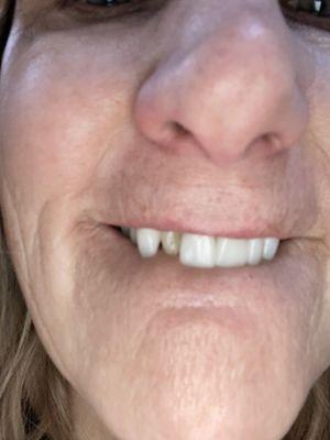 Several veneers repeatedly came off within the first 30 days.