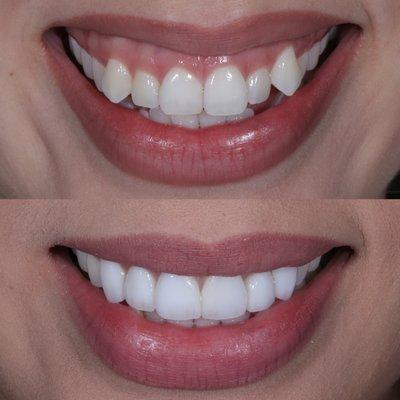 Porcelain veneers before/after!