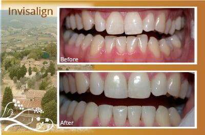 Dr. Dixon is an experienced, certified Invisalign provider (  a series of clear plastic retainers for straightening your teeth)