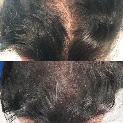 NeoGraft Hair Transplant, 2500 Grafts. Bottom photo is 1 year after procedure.