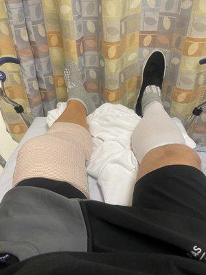 Torn Meniscus Surgery