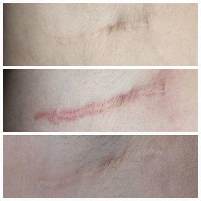 Scar work.  1 session,  improved texture. Additional sessions needed.