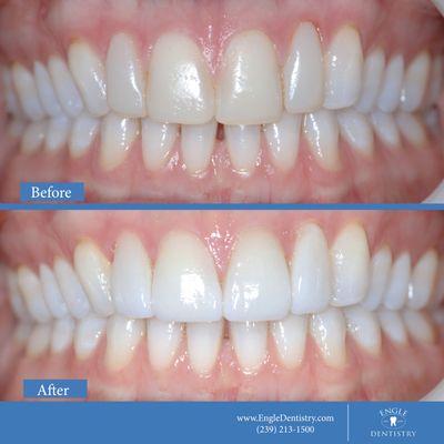 Before & After Smile Makeover