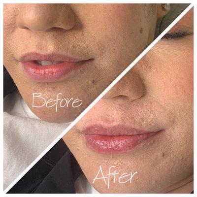 1ML Hyaluronic Acid Lip Filler  Natural Plump, Instant results, No downtime   Non-invasive, needle-less, Pain free