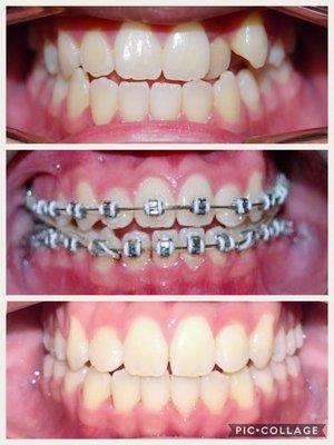 Braces