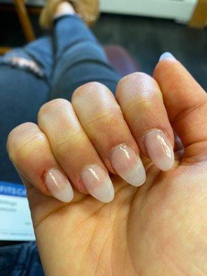 Crooked nails with bloody cuticles