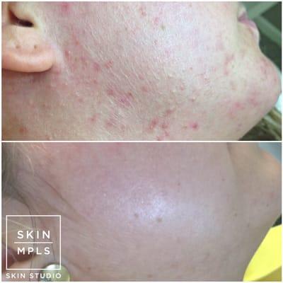 Typical results of our acne program. We pair in-office acne treatments with at-home skincare. Each of our aestheticians is an acne expert.