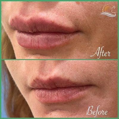 Lip fillers