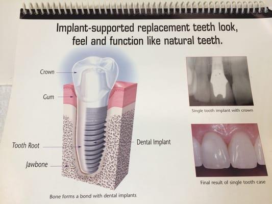 Example of implant I received.