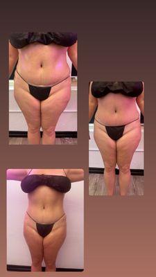 Clay detox body wraps combined with cavitation/ body Contouring