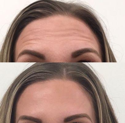 We smoothened out her forehead and frown lines with Botox.. She wanted a smoother makeup application and look