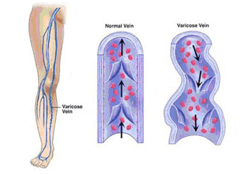 In the vein clinic, top vein doctor and venous disease expert ensure the removal of painful varicose veins.