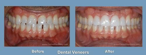 Miami Dentist and dental Veneers