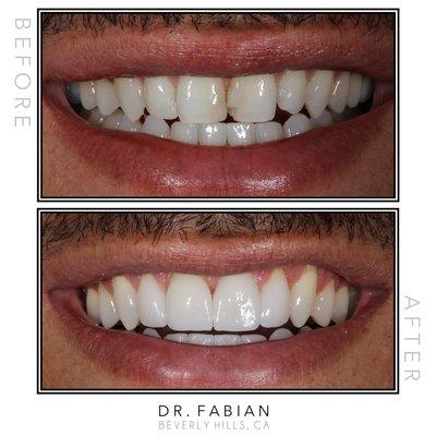 4 veneers were able to restore this young man's smile after years of chipped bonding and staining.