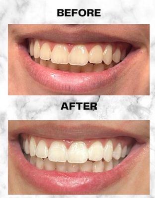 1 hour teeth whitening