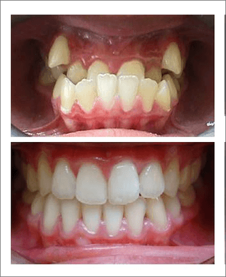 Underbite Before and After