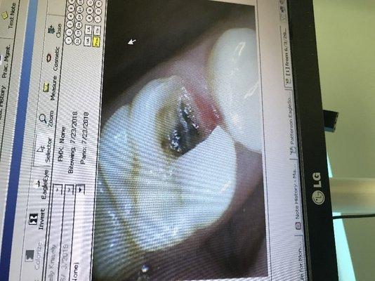 My tooth