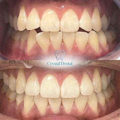 Invisalign and Teeth Whitening at Crystal Dental