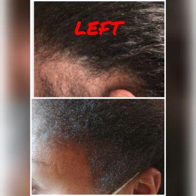 Female hair loss