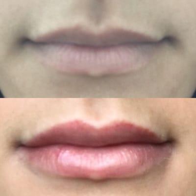 Lip filler. Before and After