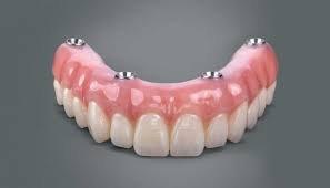 Hybrid Denture. Attach to implants.