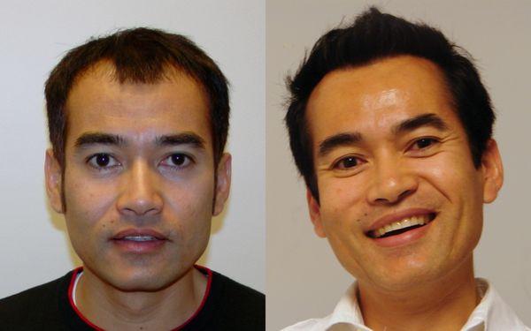 Before and After Hair Restoration