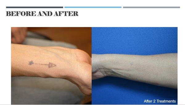 Before and after 2 treatments with Spectra Q-Switch Laser Tattoo Removal Treatment.