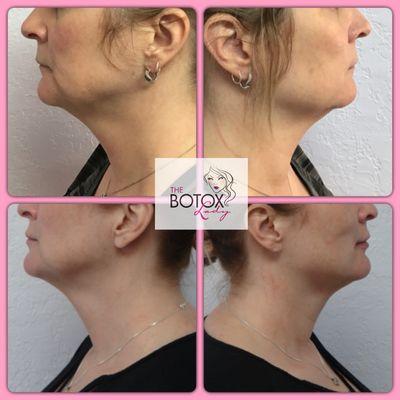 No more "turkey neck" thanks to Ultherapy.