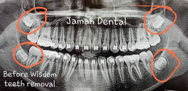 All wisdom teeth REMOVAL under sedation with bone grafting is a one-time deal that you don't have to worry about for the rest of your life