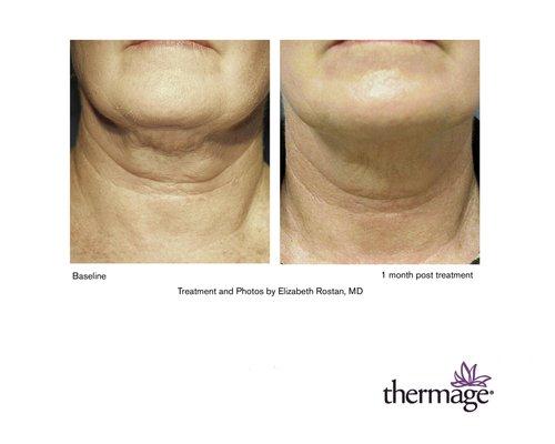 Thermage CPT tightens skin. Non-invasive and only one treatment needed.