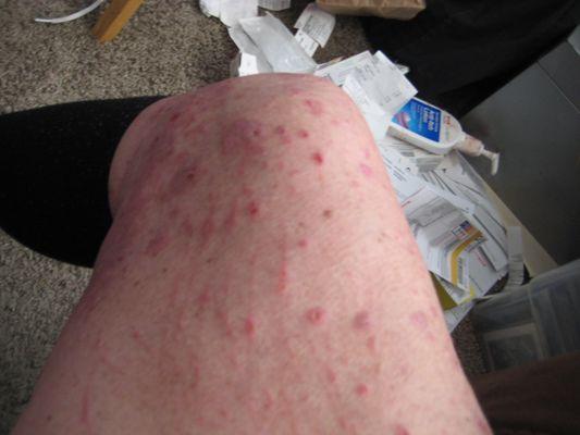 Open sores all over my legs, arms & back.