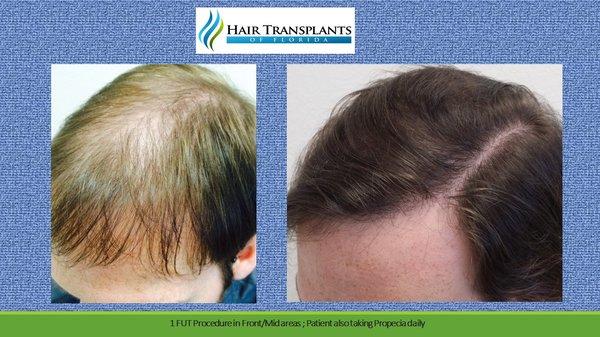 Patient is 27 years old with thinning in front and mid areas.  Had 1 hair transplant procedure and also got started on Propecia.