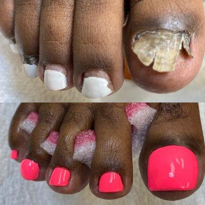 Toenail Restoration with Fungal Treatment