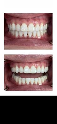 Results after 6 months Invisalign