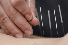 Acupuncture - the most popular treatment of ancient oriental medicine