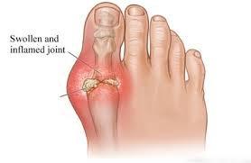 Swollen and inflamed joint