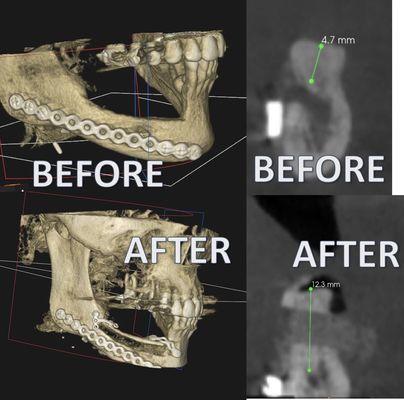 Bone grafting a large defect