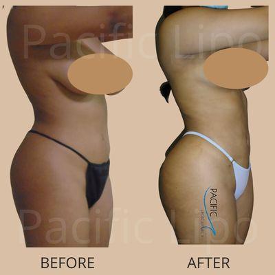 lipo with Jplasma skin tightening