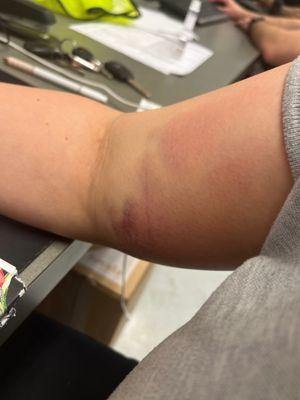 Right arm (arm they had to restick and hurt