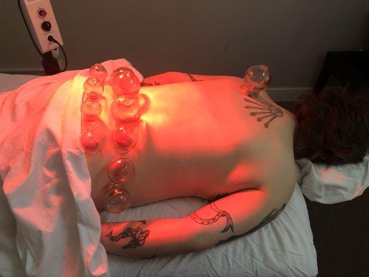 Acupuncture and cupping can be extremely effective in reducing low back and hip pain.