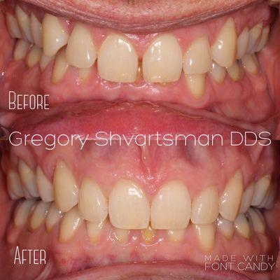 Before and after Invisalign treatment to correct gaps and improved this patient's deep bite.