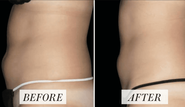 Body Cavitation & Weight Loss