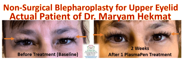 Non-Surgical Blepharoplasty for Upper eyelid with Plexr Plasma