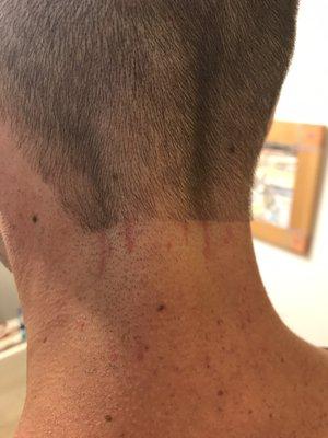 Numerous cuts from clippers digging into my skin