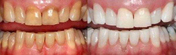 TEETH BLEACHING