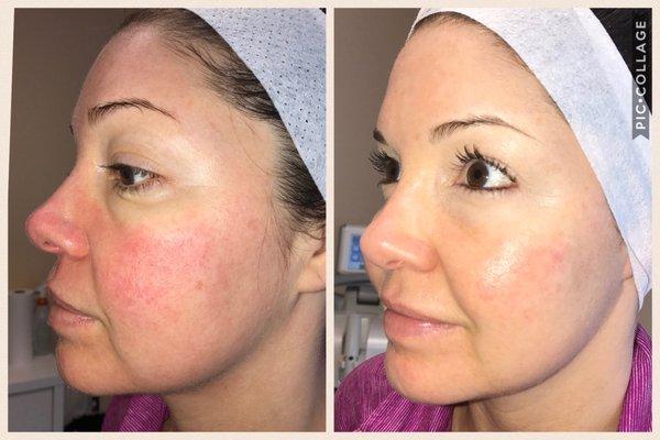 redness removal