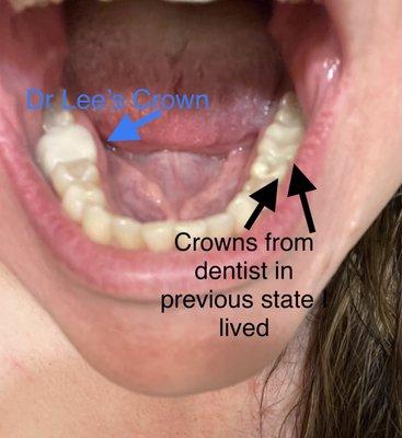 Dr Lees Crown to the right, compared to work from the dentist in a town from my previous residence