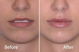 Lip augmentation