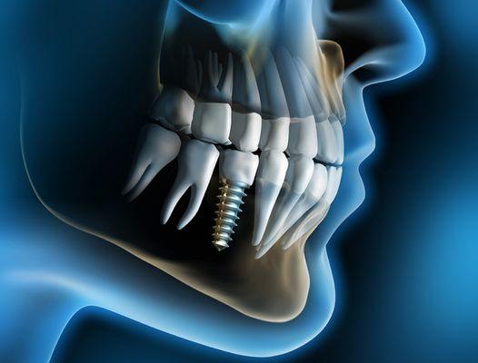 Your dental implant specialist right here in Allen, TX!